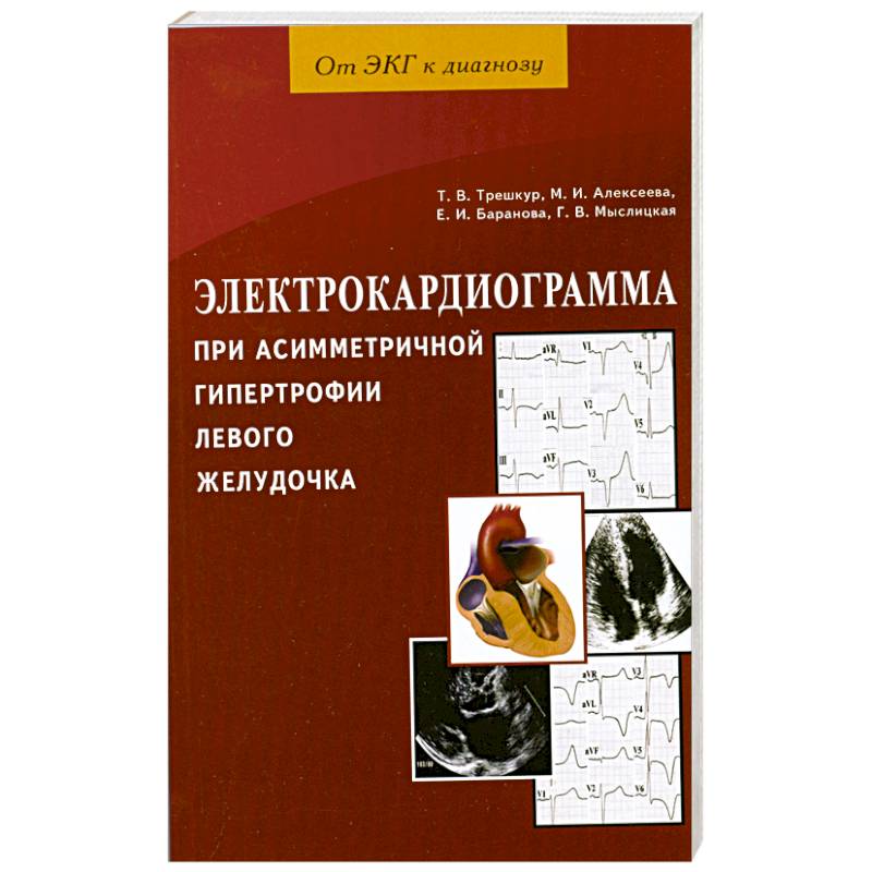 Электрокардиограмма при асимметричной гипертрофии левого желудочка